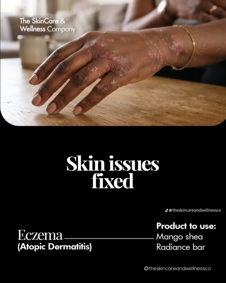 Eczema-Prone Skin