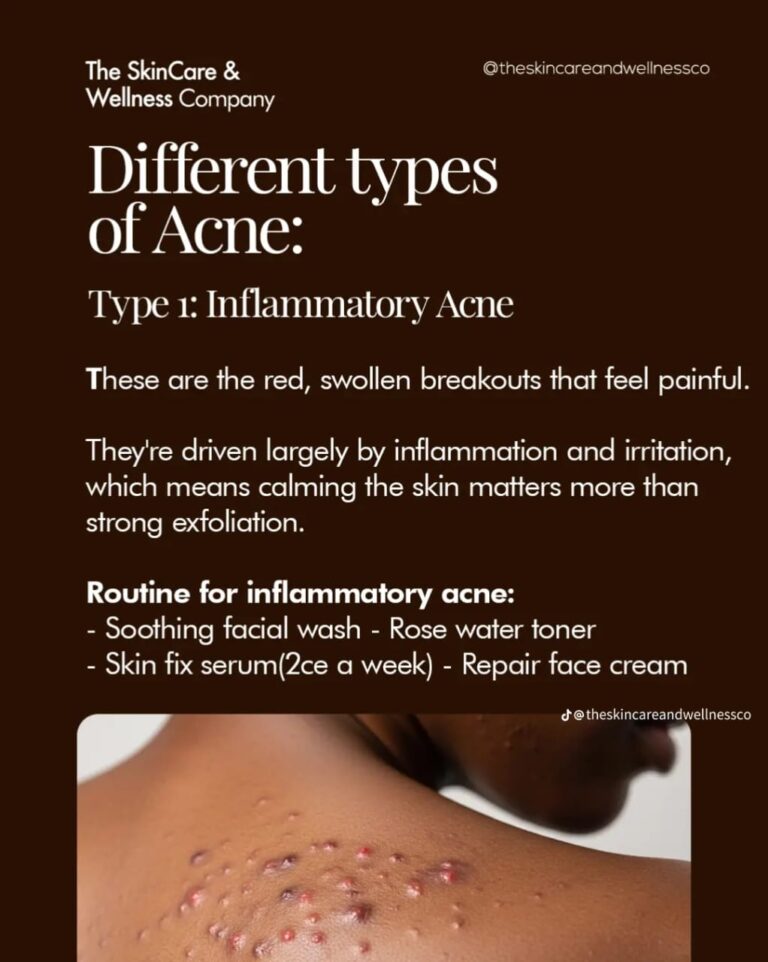 Caring for Skin Acne